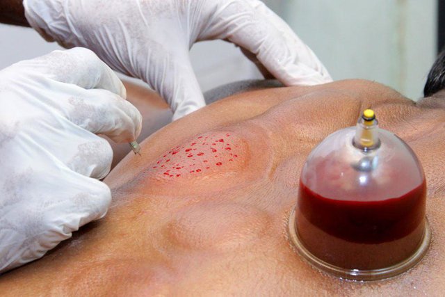 همه چیز درباره حجامت در فصل بهار/حجامت برای کدام افراد ممنوع است؟