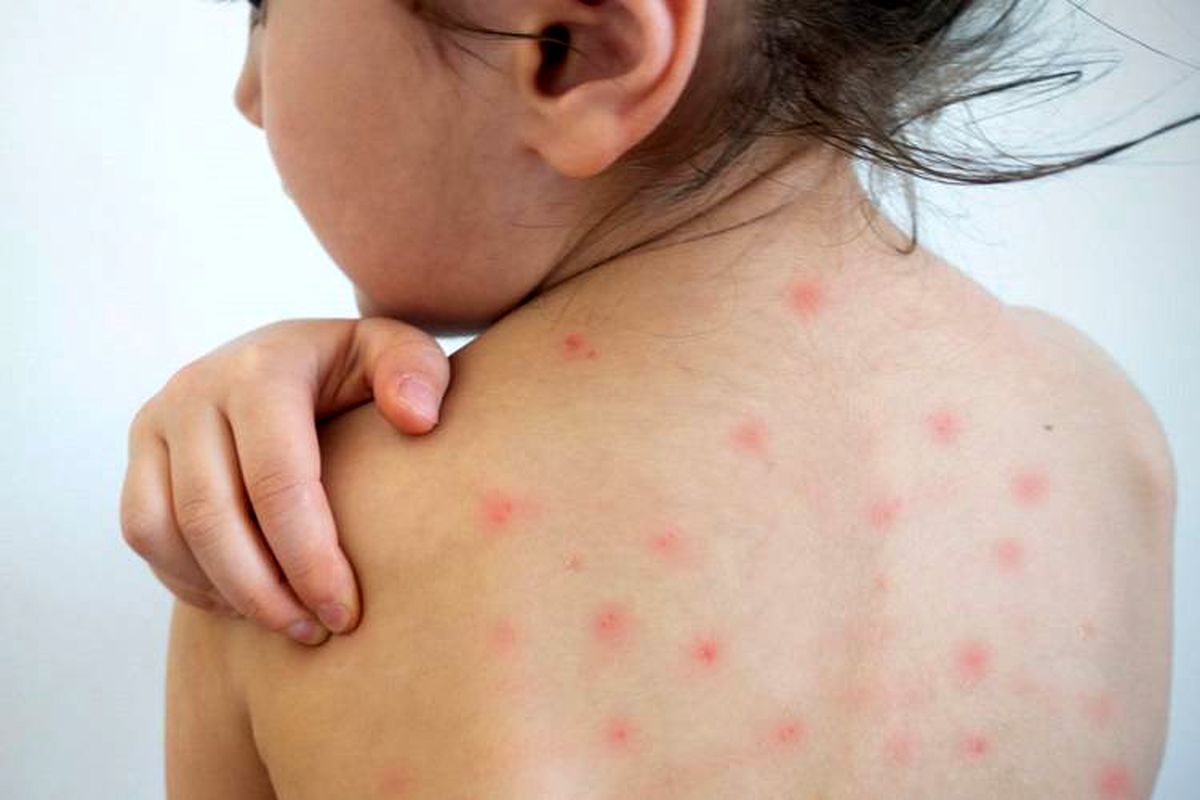 موارد مشکوک بیماری سرخک به سرعت اعلام شود