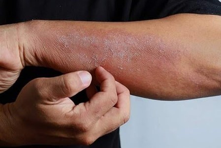 بلاهایی که کرونا بر سر پوست می‌آورد